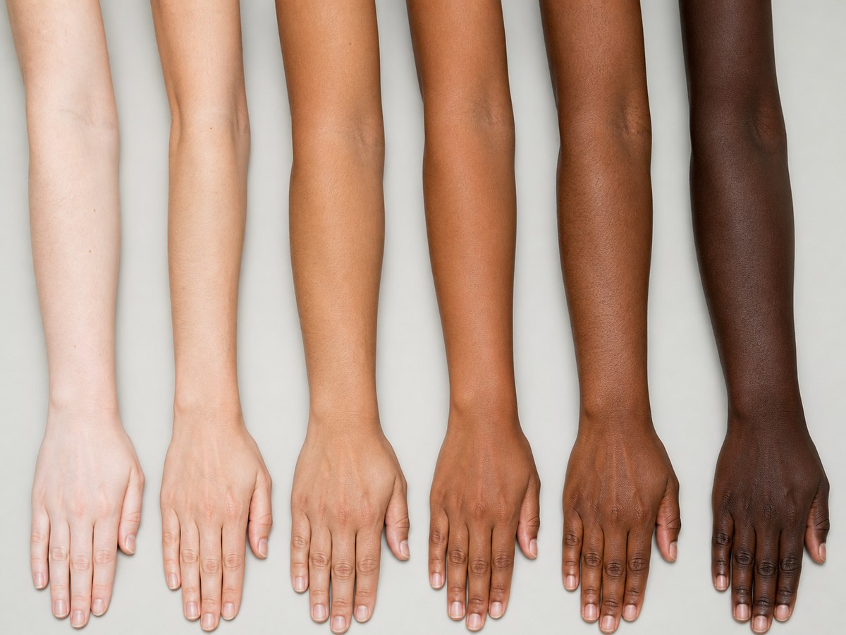 Skin tones — the phototype scale